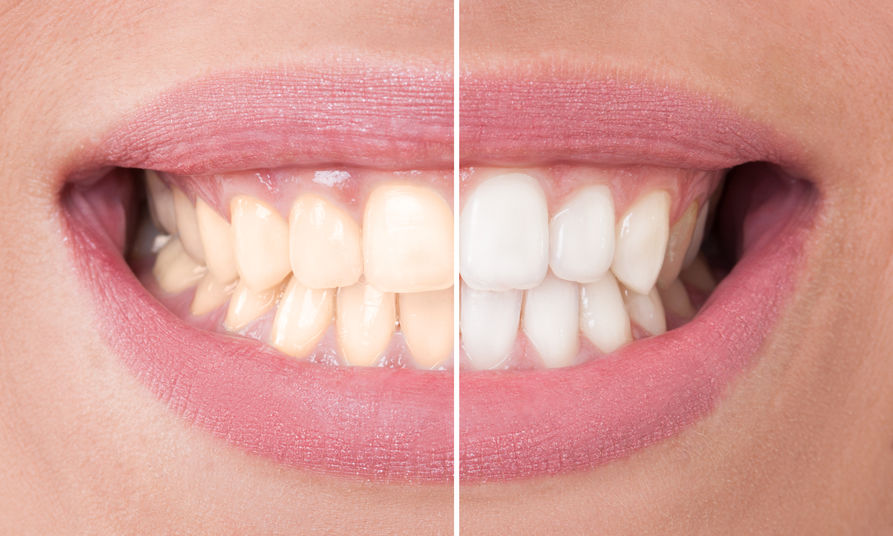Igiene dentale: prima - dopo